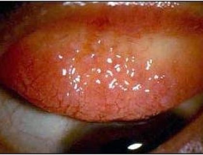 Allergic Conjunctivitis