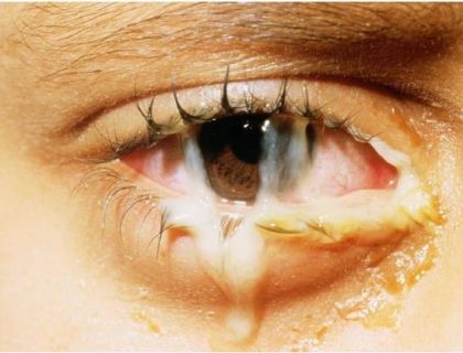 Bacterial Conjunctivitis
