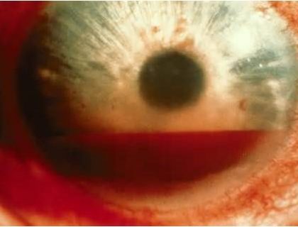 Hyphema