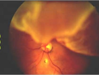 Retinal Detachment