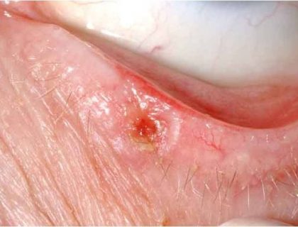 Squamous Cell Carcinoma