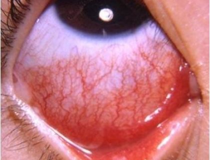 Viral Conjunctivitis
