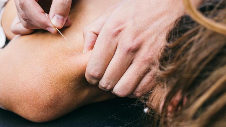 Thinkstockphotos 490484202 Dry Needling Thinkstockphotos 490484202 Dry Needling