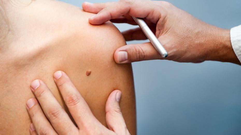 Thinkstockphotos 524997413 Birthmark Thinkstockphotos 524997413 Birthmark