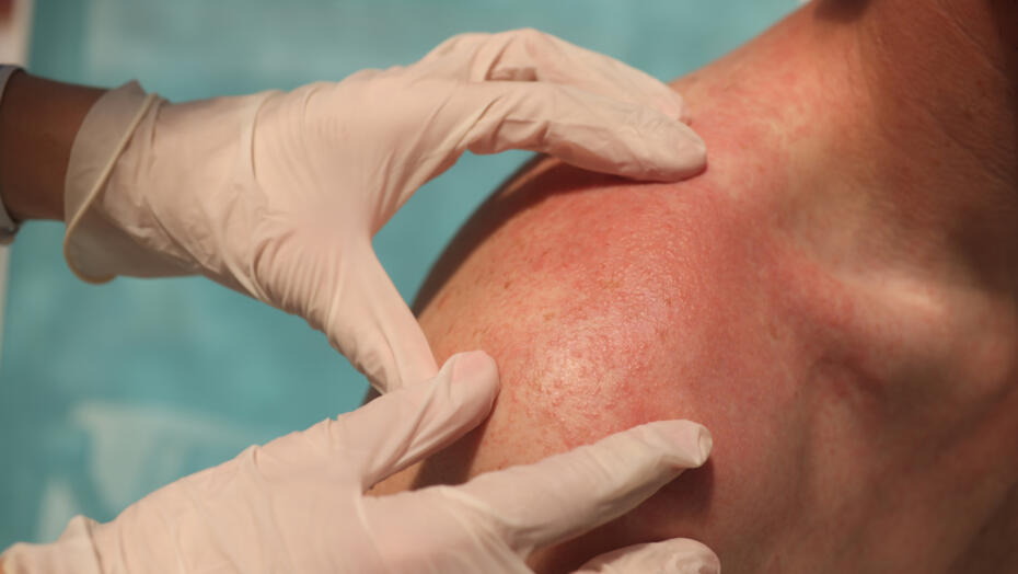 Patient with back rash Patient with back rash