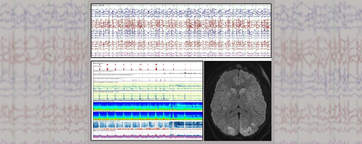 Management of Refractory and Super Refractory Status Epilepticus for Neurologists and Intensivists