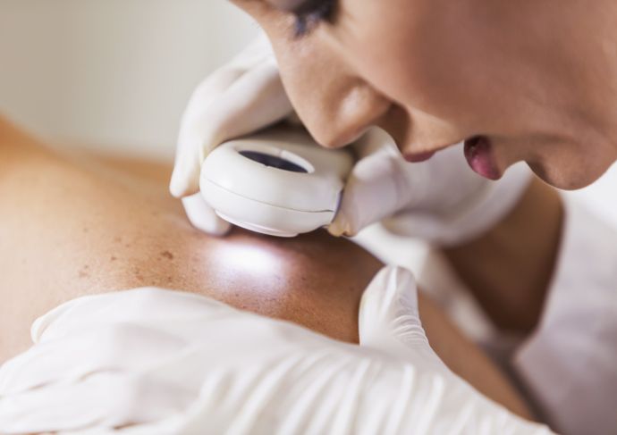 Dermatologist checking skin tag