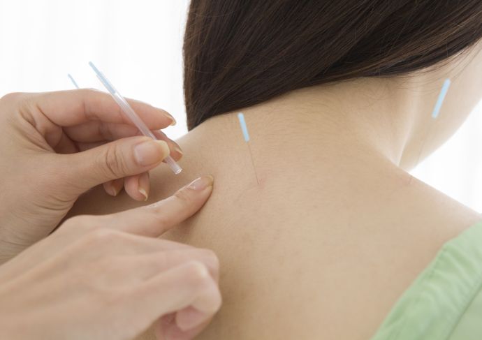 Acupuncture upperback