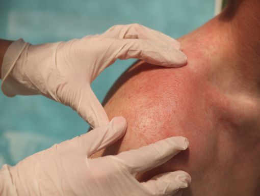 Patient with back rash