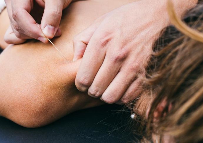Thinkstockphotos 490484202 Dry Needling