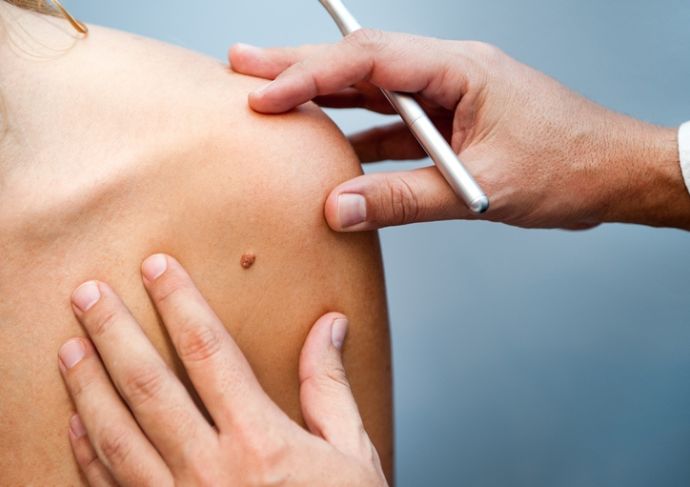 Thinkstockphotos 524997413 Birthmark