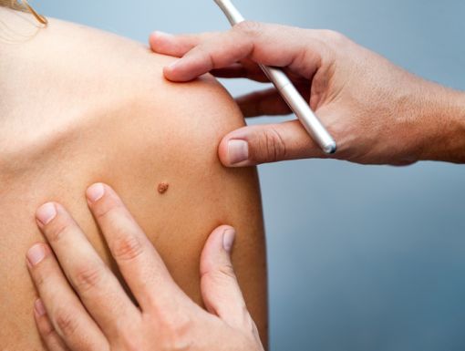 Thinkstockphotos 524997413 Birthmark