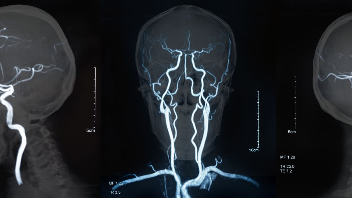 photo of brain MRI