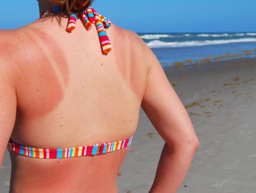 Sunburned woman Getty