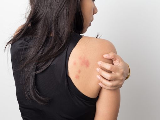 Woman Itching Back Getty Images 1003986104
