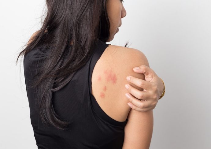 Woman in black tank top rubbing rash on her back