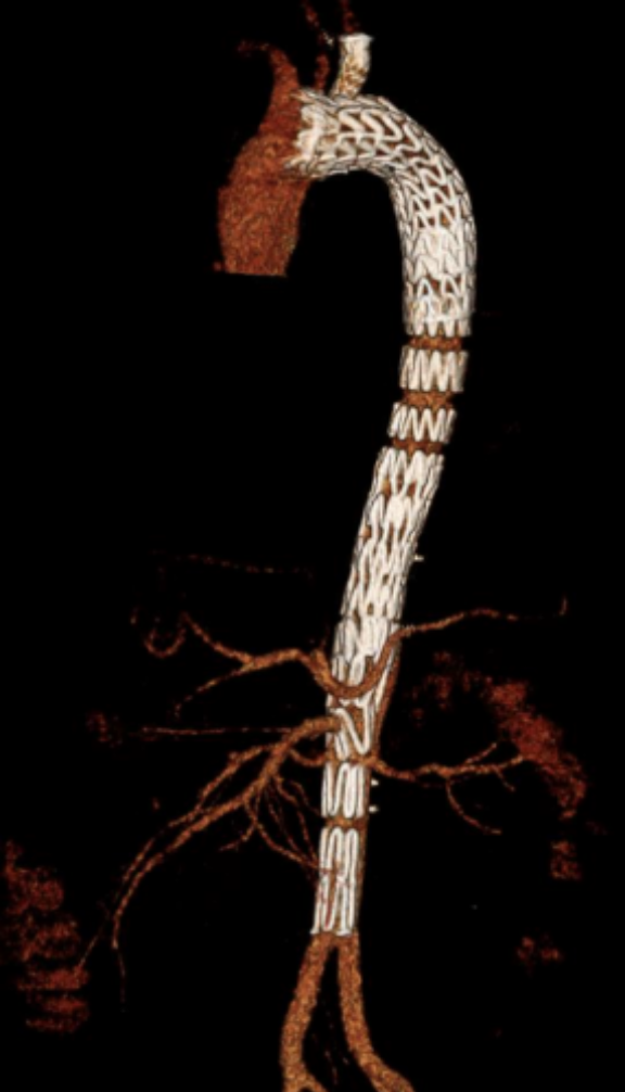 Thoracic Endovascular Aortic Repair