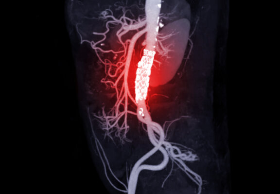 Abdominal aorta with stent grafting in patient Abdominal aortic aneurysm