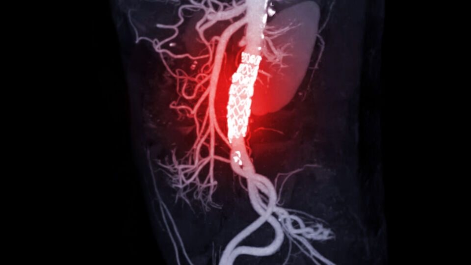 Abdominal aorta with stent grafting in patient Abdominal aortic aneurysm